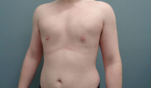 GYNECOMASTIA BEFORE & AFTER PICTURES IN NASHVILLE, TN