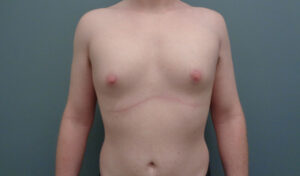 GYNECOMASTIA BEFORE & AFTER PICTURES IN NASHVILLE, TN
