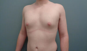 GYNECOMASTIA BEFORE & AFTER PICTURES IN NASHVILLE, TN