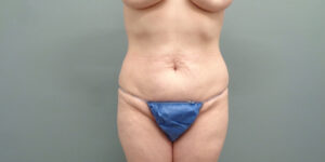 Tummy Tuck Before & After Pictures in Nashville, TN