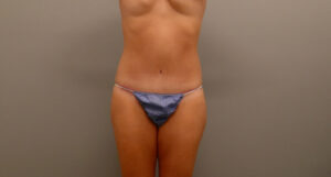 TUMMY TUCK BEFORE & AFTER PICTURES IN NASHVILLE, TN