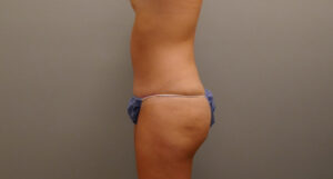 TUMMY TUCK BEFORE & AFTER PICTURES IN NASHVILLE, TN