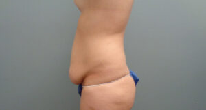 TUMMY TUCK BEFORE & AFTER PICTURES IN NASHVILLE, TN