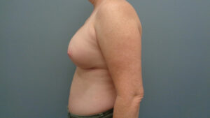 BREAST AUGMENTATION BEFORE & AFTER PICTURES IN NASHVILLE, TN