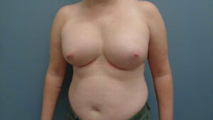 BREAST AUGMENTATION BEFORE & AFTER PICTURES IN NASHVILLE, TN