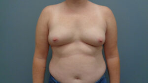 BREAST AUGMENTATION BEFORE & AFTER PICTURES IN NASHVILLE, TN