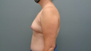 BREAST AUGMENTATION BEFORE & AFTER PICTURES IN NASHVILLE, TN