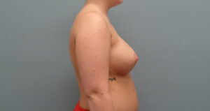 BREAST AUGMENTATION BEFORE & AFTER PICTURES IN NASHVILLE, TN