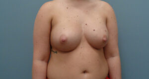 BREAST AUGMENTATION BEFORE & AFTER PICTURES IN NASHVILLE, TN