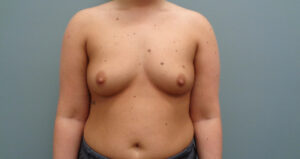 BREAST AUGMENTATION BEFORE & AFTER PICTURES IN NASHVILLE, TN