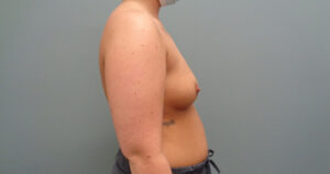 BREAST AUGMENTATION BEFORE & AFTER PICTURES IN NASHVILLE, TN