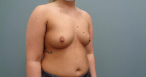 BREAST AUGMENTATION BEFORE & AFTER PICTURES IN NASHVILLE, TN