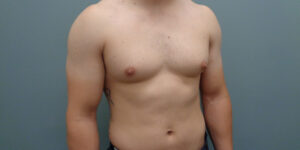 Gynecomastia Before & After Pictures in Nashville, TN