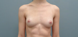 BREAST AUGMENTATION BEFORE & AFTER PICTURES IN NASHVILLE, TN