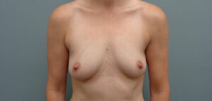 Breast Augmentation Before & After Pictures in Nashville, TN