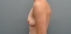 Breast Augmentation Before & After Pictures in Nashville, TN