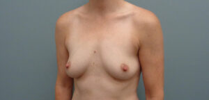 Breast Augmentation Before & After Pictures in Nashville, TN