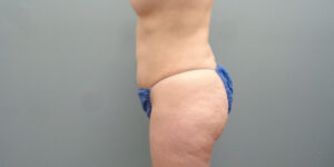 THIGH LIFT BEFORE & AFTER PICTURES IN NASHVILLE, TN