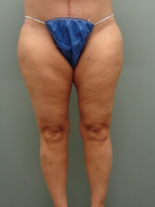 THIGH LIFT BEFORE & AFTER PICTURES IN NASHVILLE, TN