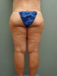THIGH LIFT BEFORE & AFTER PICTURES IN NASHVILLE, TN