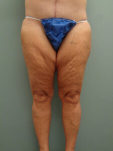 THIGH LIFT BEFORE & AFTER PICTURES IN NASHVILLE, TN