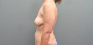 BREAST AUGMENTATION WITH LIFT BEFORE & AFTER PICTURES IN NASHVILLE, TN