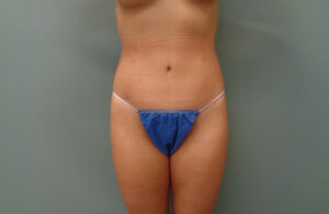 TUMMY TUCK BEFORE & AFTER PICTURES IN NASHVILLE, TN