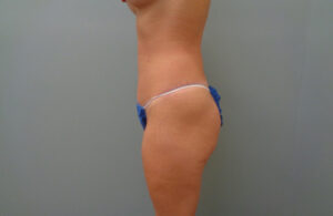 TUMMY TUCK BEFORE & AFTER PICTURES IN NASHVILLE, TN