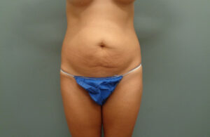 TUMMY TUCK BEFORE & AFTER PICTURES IN NASHVILLE, TN