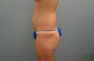 TUMMY TUCK BEFORE & AFTER PICTURES IN NASHVILLE, TN