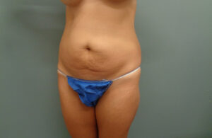 TUMMY TUCK BEFORE & AFTER PICTURES IN NASHVILLE, TN