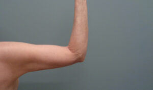 Arm Lift Before and After Pictures Nashville, TN