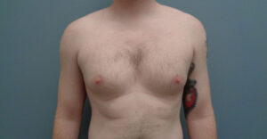 Gynecomastia Before & After Pictures in Nashville, TN