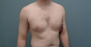 Gynecomastia Before & After Pictures in Nashville, TN