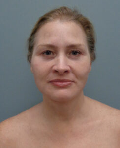 Facelift Before & After Pictures in Nashville, TN