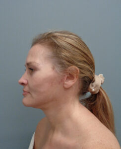 Facelift Before & After Pictures in Nashville, TN