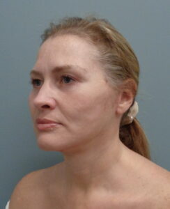 Facelift Before & After Pictures in Nashville, TN