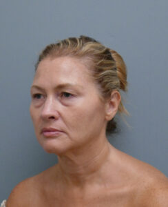 Facelift Before & After Pictures in Nashville, TN