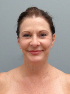 FACELIFT BEFORE & AFTER PICTURES IN NASHVILLE, TN