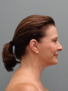 FACELIFT BEFORE & AFTER PICTURES IN NASHVILLE, TN