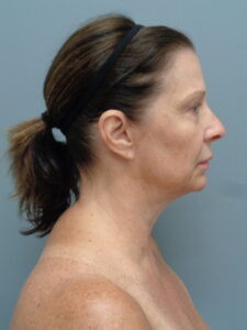 FACELIFT BEFORE & AFTER PICTURES IN NASHVILLE, TN