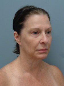 FACELIFT BEFORE & AFTER PICTURES IN NASHVILLE, TN