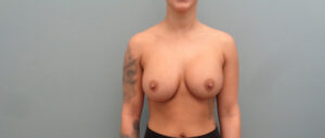 BREAST AUGMENTATION BEFORE & AFTER PICTURES IN NASHVILLE, TN