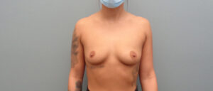 BREAST AUGMENTATION BEFORE & AFTER PICTURES IN NASHVILLE, TN