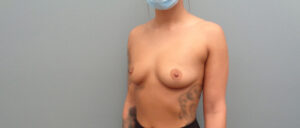 BREAST AUGMENTATION BEFORE & AFTER PICTURES IN NASHVILLE, TN