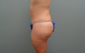 Tummy Tuck Before & After Pictures in Nashville, TN