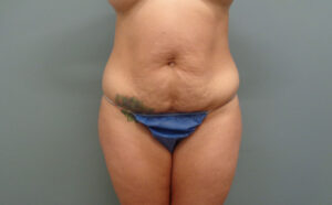 Tummy Tuck Before & After Pictures in Nashville, TN