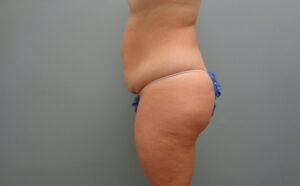 Tummy Tuck Before & After Pictures in Nashville, TN