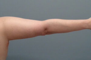 Arm Lift Before and After Pictures Nashville, TN