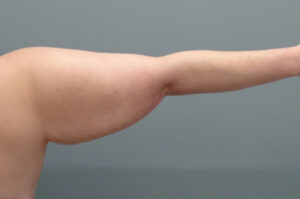 Arm Lift Before and After Pictures Nashville, TN